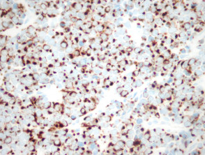 CD20 + en patología del carcinoma de células de Merkel