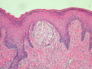 Patología metastásica de la enfermedad de Crohn