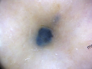 Dermatoscopia de melanoma metastásico