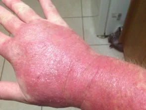 Dermatitis de contacto por metilisotiazolinona