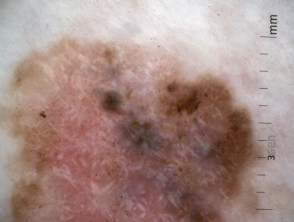 Dermatoscopia in situ de melanoma