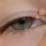 molluscum-contagiosum-eyelid__protectwyjqcm90zwn0il0_focusfillwzi5ncwymjisingildfd-3413060-7297615-jpg-9776121