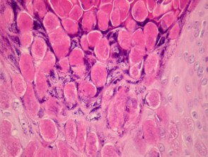 Molluscum contagiosum Pathologie