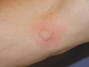 Picadura de mosquito 