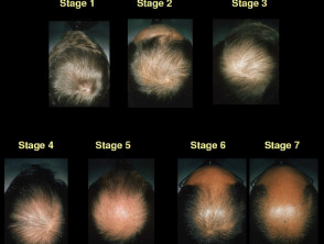 Clasificación de Sinclair de alopecia de patrón masculino