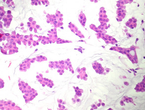 Patología del carcinoma mucinoso