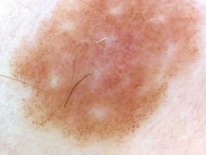 Nevus atípico