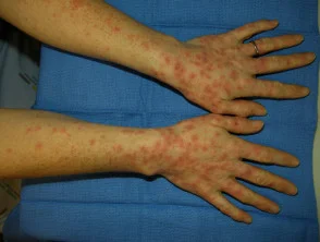 Erythema multiforme