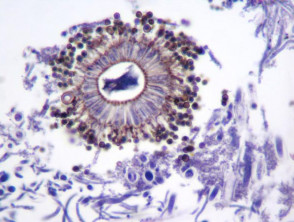 Patología del micetoma
