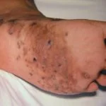 mycetoma-foot__protectwyjqcm90zwn0il0_focusfillwzi5ncwymjisingilde0xq-4706051-5123921-jpg-3133584