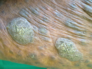 Micosis fungoide en estadio tumoral