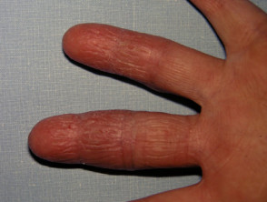 Micosis fungoide palmaris