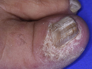 Micosis fungoide que afecta a la uña del pie
