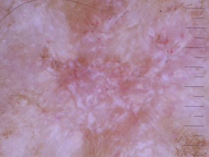 Dermoscopia del carcinoma a cellule basali nodulari