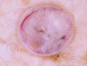 Dermatoscopia polarizada de un carcinoma nodular de células basales que se presenta como un pólipo exofítico