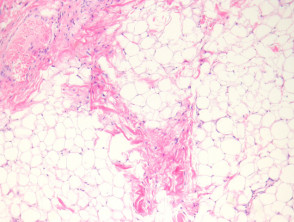 Patología del nevus lipomatosus superficialis