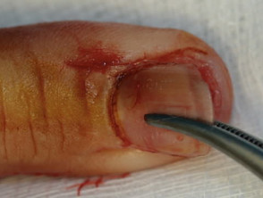 Biopsia de uñas