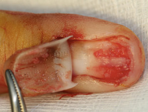 Biopsia de uñas