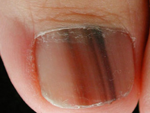 Unidad de melanoma de uñas