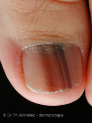 Melanoma de uñas