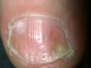 Psoriasis ungueal