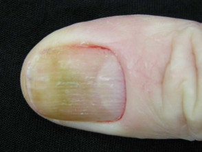 Onicólisis como reacción a las uñas artificiales.