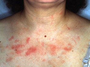Dermatitis torácica por alergia al esmalte de uñas 