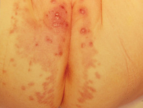 Dermatitis de la servilleta