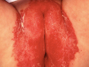 Dermatitis de la servilleta