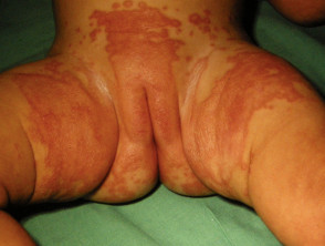 Dermatitis de la servilleta