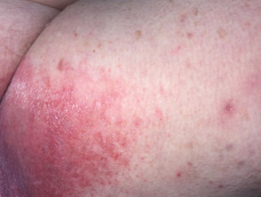 Dermatitis por contacto irritante por orina.  Dermatitis de la servilleta en adultos.