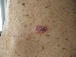 Carcinoma basocellulare nodulare, braccio