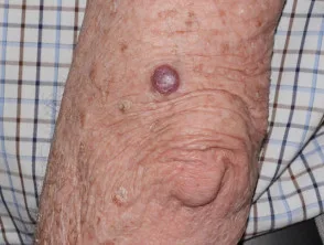 Carcinoma basocellulare nodulare, braccio