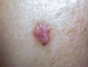 Carcinoma basocellulare nodulare, braccio