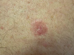 Carcinoma basocellulare nodulare, braccio