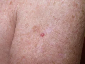 Carcinoma basocellulare nodulare, braccio