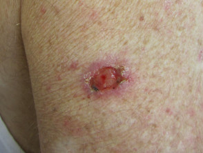 Carcinoma nodular de células basales, brazo