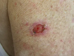 Carcinoma basocellulare nodulare, braccio