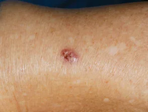 Carcinoma basocellulare nodulare, braccio