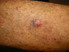 Carcinoma nodular de células basales, pierna