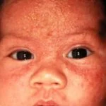 neonatal-acne3__protectwyjqcm90zwn0il0_focusfillwzi5ncwymjisinkildg0xq-9463807-5299058-jpg-7941591