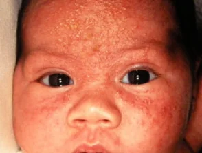 neonatale-acne3__protectwyjqcm90zwn0il0_focusfillwzi5ncwymjisinkildg0xq-9463807-5299058-jpg-7941591