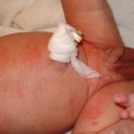 melanosi-pustolosa-neonatale-1__protectwyjqcm90zwn0il0_focusfillwzi5ncwymjisingildfd-7666463-1192062-jpg-3688072