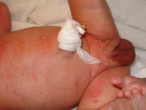 Melanosis pustulosa neonatal