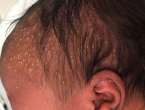 Melanosis pustulosa neonatal transitoria