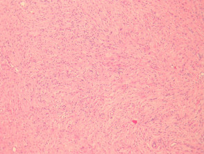 Neurofibroom pathologie