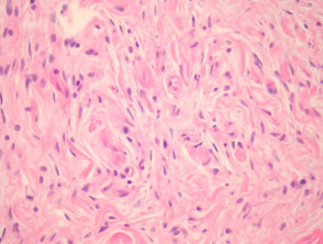 Neurofibroom pathologie