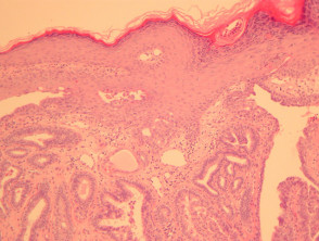 Patología de la papilomatosis erosiva del pezón