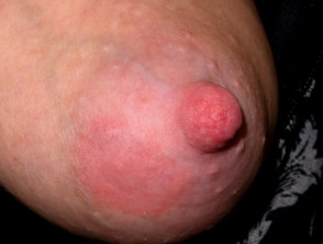 nipple-eczema-01__protectwyjqcm90zwn0il0_focusfillwzi5ncwymjisingildfd-7435949-3934943-jpg-1776567