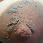 nipple-papillomatosis-01__protectwyjqcm90zwn0il0_focusfillwzi5ncwymjisingildfd-1114976-5108403-jpg-2763989